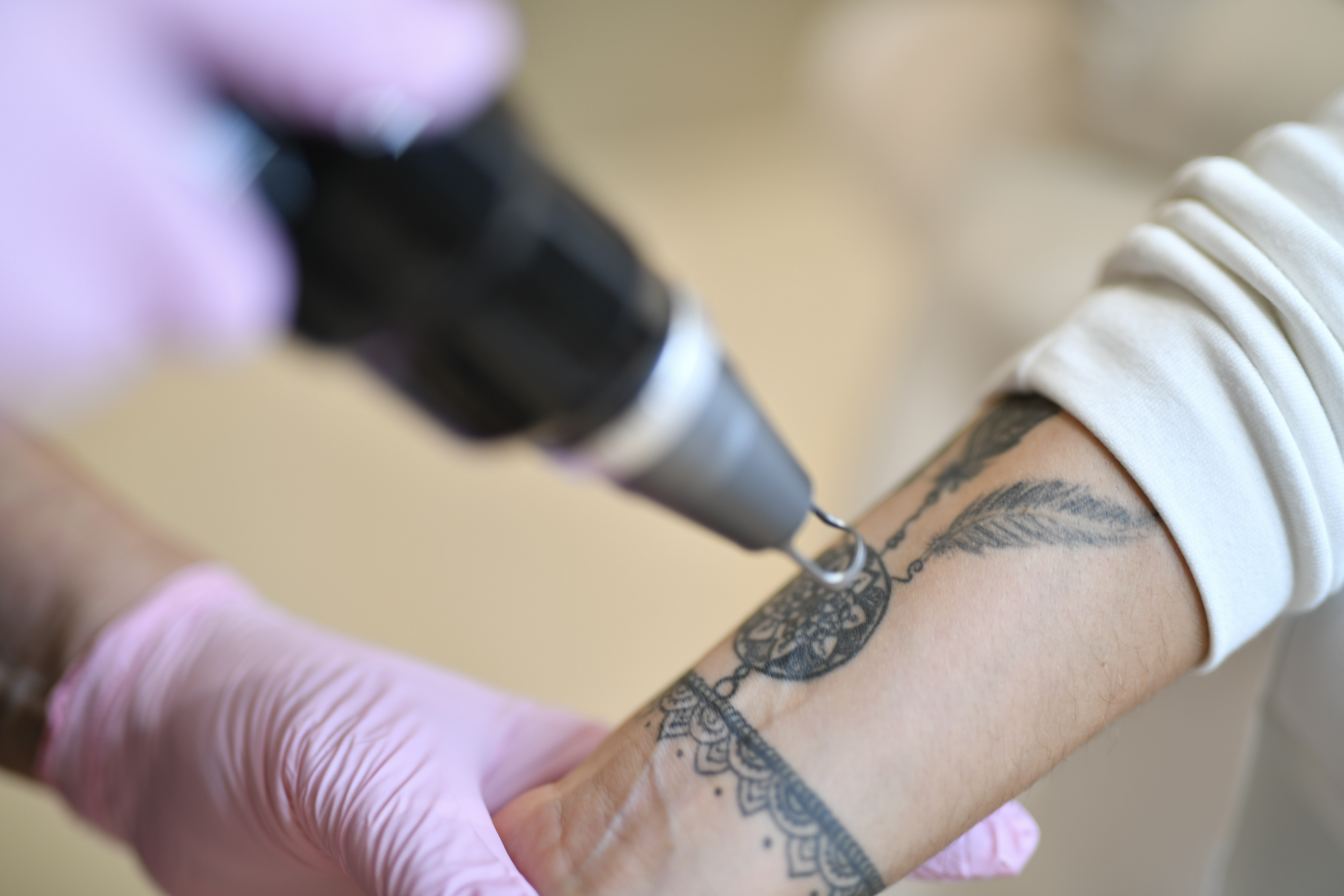 Laserbehandling av tatovering