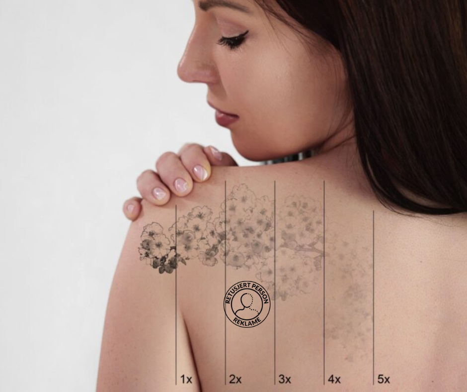 Før og etter tatoveringsfjerning - progresjon over 5 behandlinger